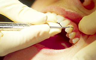 瑞穂区・ひらの歯科・スケーリングとは？