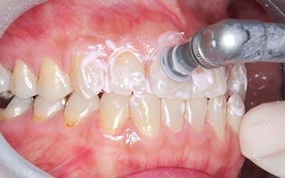 瑞穂区・ひらの歯科・PMTCとは？